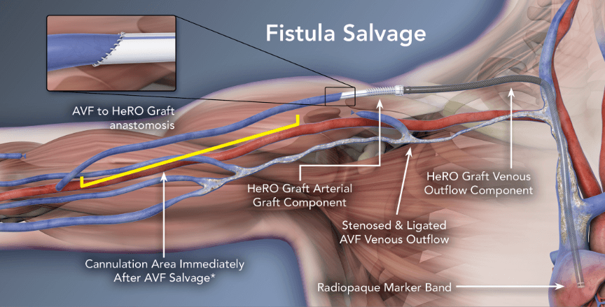 Fistula Salvage - HeRO Graft