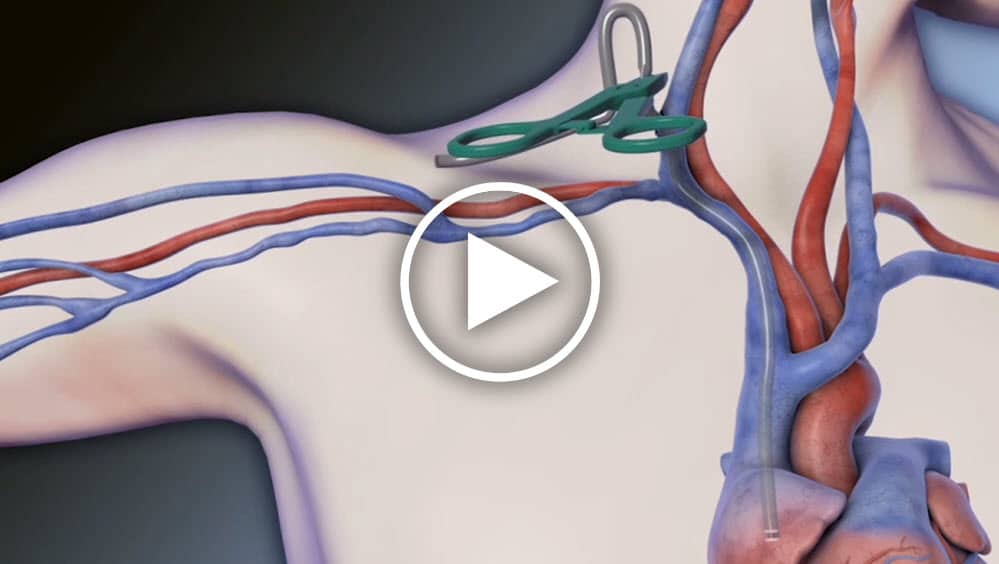 Dr. Jeffrey H. Lawson highlights the steps involved in implanting the HeRO Graft for dialysis patients.